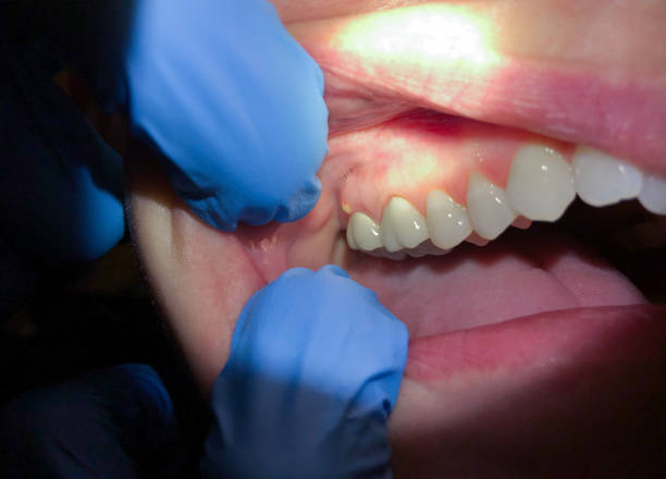 Best Cracked Tooth Emergency Dentist  in Chittenango, NY